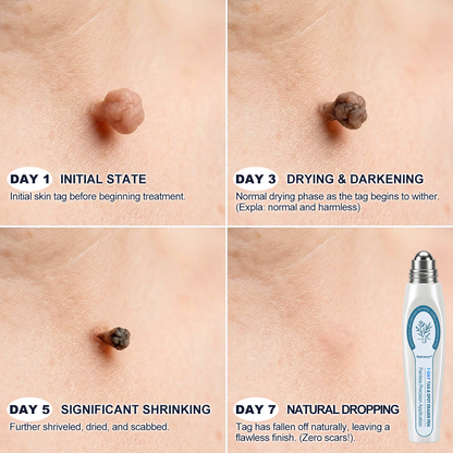 🎁Only 5 left — Add your second one and get 50% OFF! |✅🎉Natravor® 7-𝐷𝑎𝑦 𝗧𝐚𝐠 & 𝗦𝗽𝐨𝐭 𝐄𝐫𝒂𝒔𝒆𝒓(Zero Pain, Zero 𝐒𝐜𝐚𝒓𝒔 Rollerball)